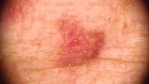711_precancer de piel