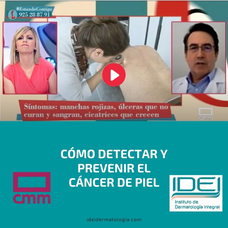 Cómo detectar y prevenir el cáncer de piel