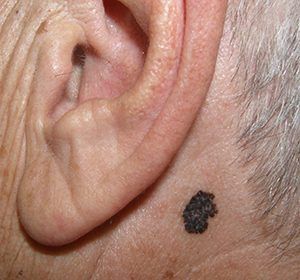 MELANOMA 1 WEB