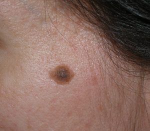 TUMOR BENIGNO WEB 1