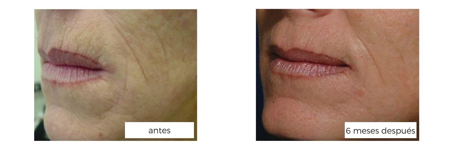 eliminar arrugas con laser burane