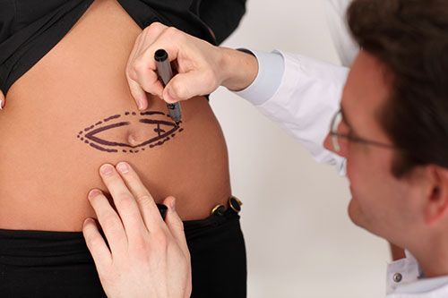 abdominoplastia-en-clinica-idei