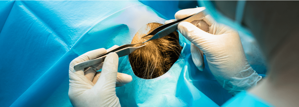 técnica fue contra la alopecia en IDEI