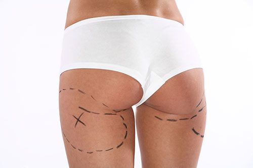 liposuccion-en-clinica-idei