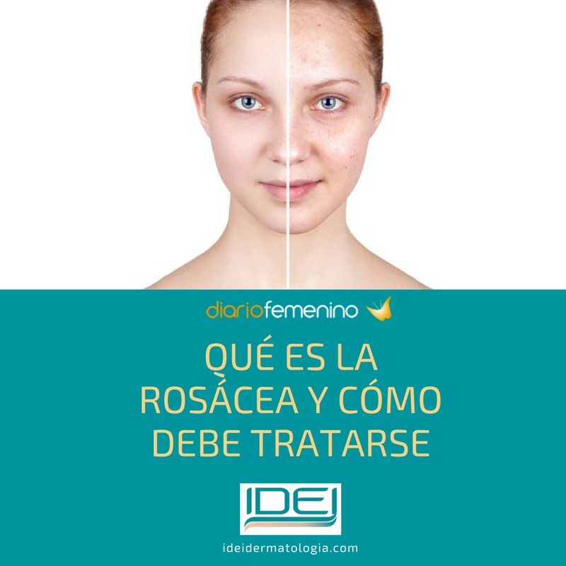 El mejor tratamiento para la rosácea