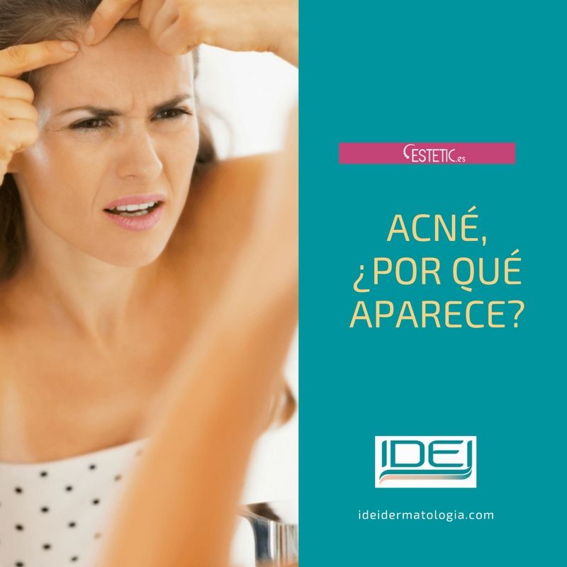 Acné, por qué aparece