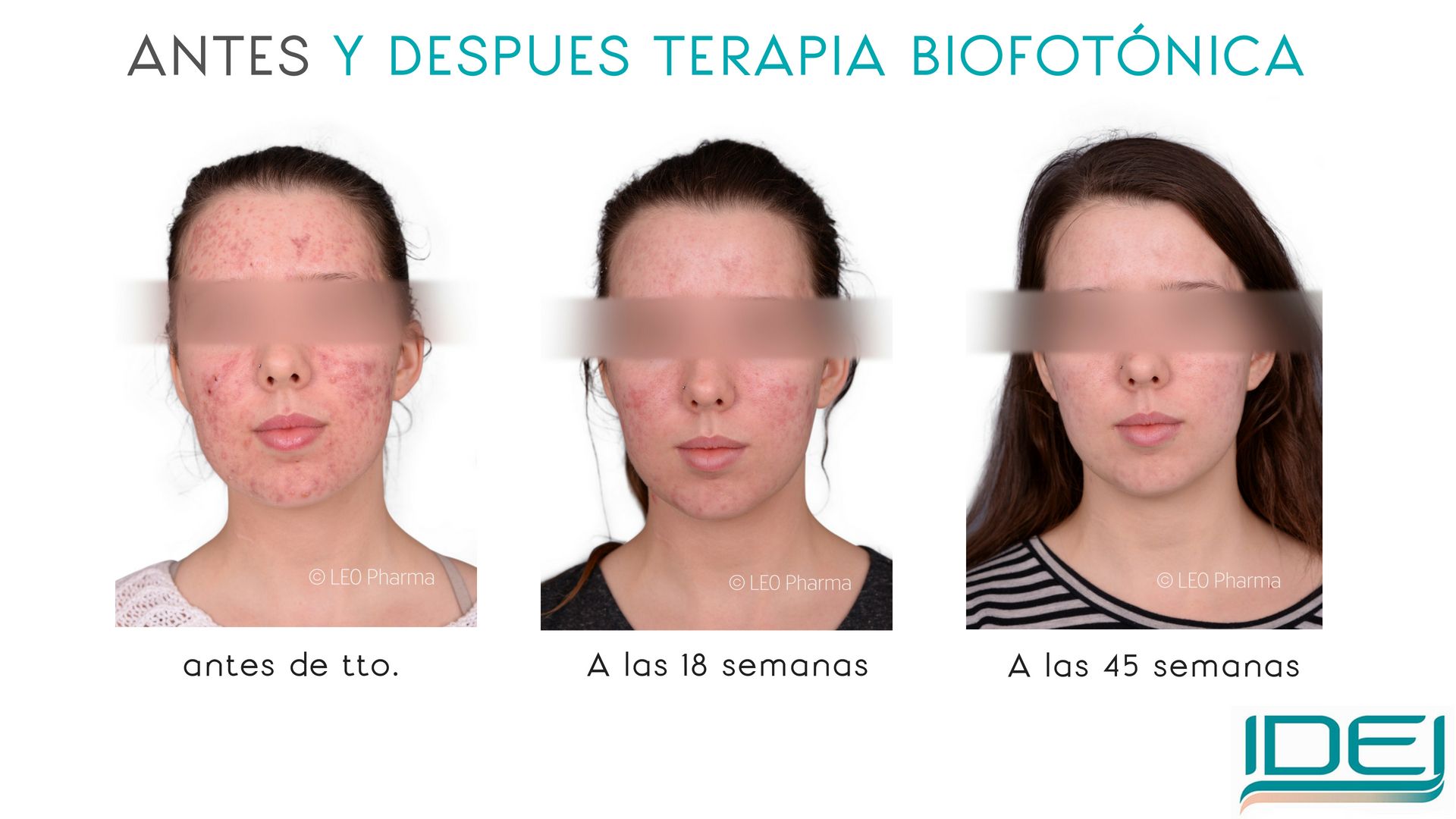 TERAPIA BIOFOTÓNICA PARA EL ACNE FOTOS ANTES Y DESPUÉS