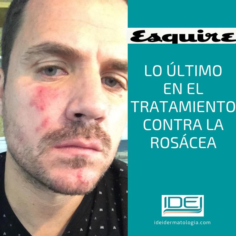Lo último en el tratamiento contra la rosácea