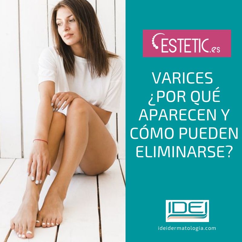 por qué aparecen las varices y cómo pueden eliminarse