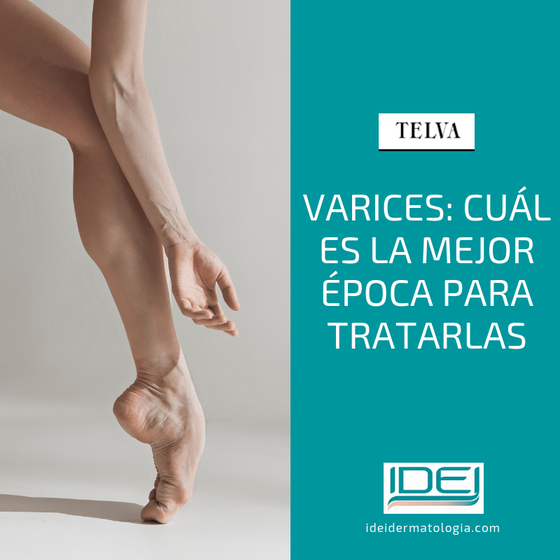 Varices: cuál es la mejor época para tratarlas