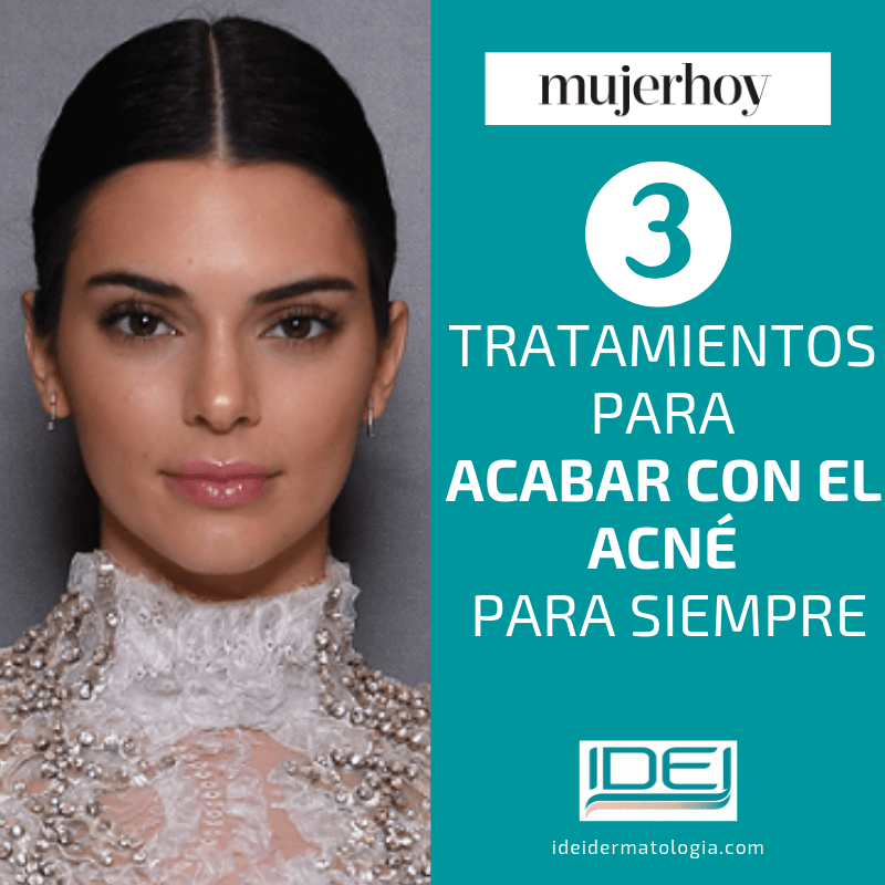 3 tratamientos para acabar con el acné para siempre