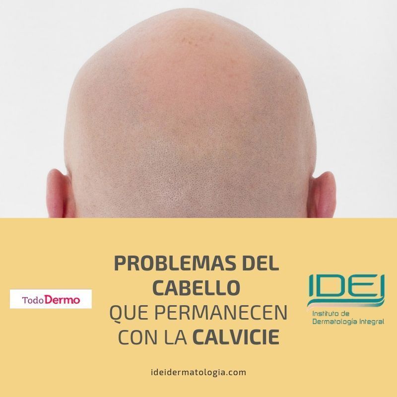 Problemas del cabello que permanecen con la calvicie