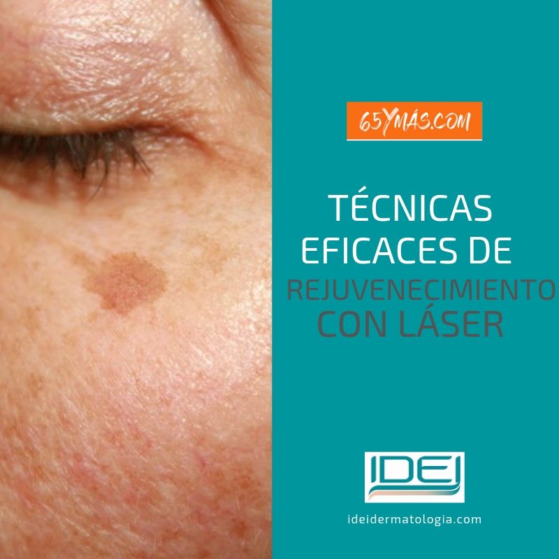 Técnicas eficaces de rejuvenecimiento con láser