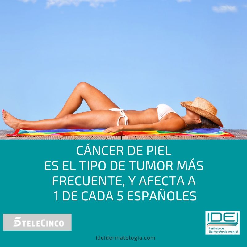 El 90% de los cánceres de piel se pueden prevenir