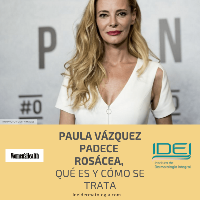 Paula Vázquez y Dani Martín padecen Rosácea, qué es y cómo se trata