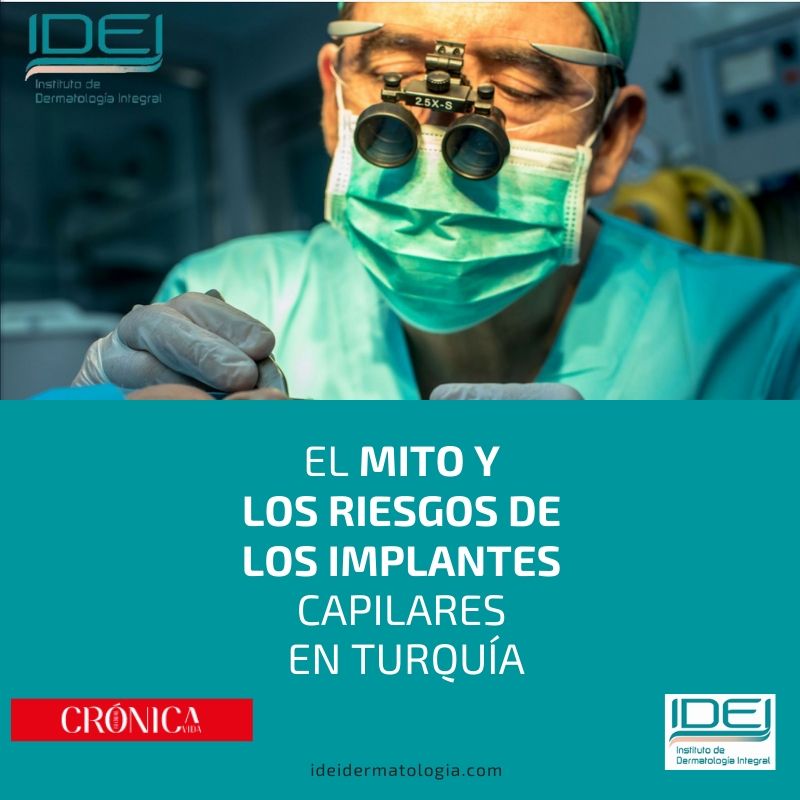 El mito y los riesgos de los implantes capilares en Turquía