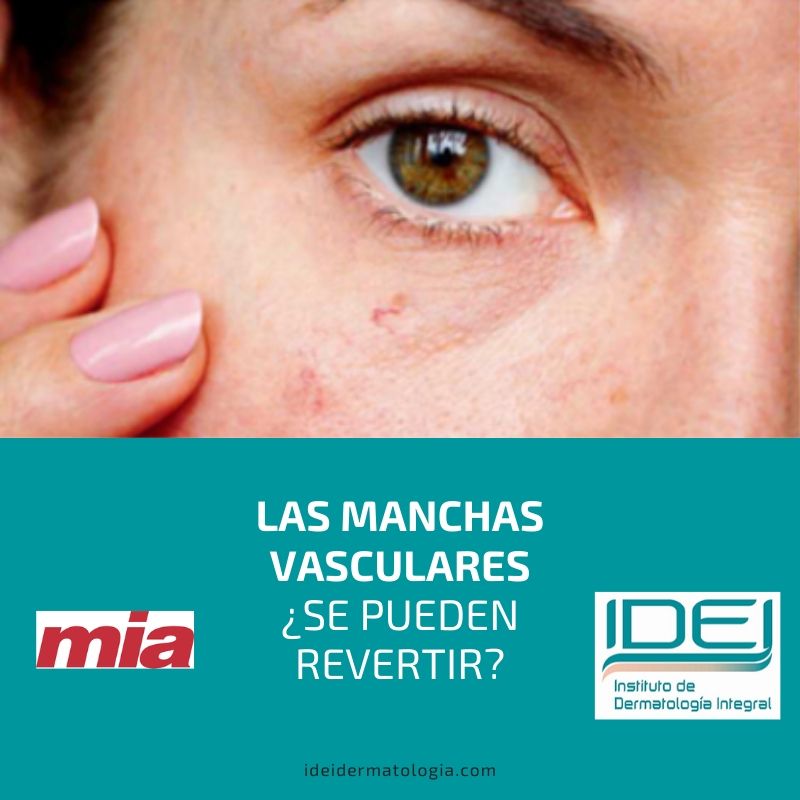 Manchas vasculares; cómo tratarlas