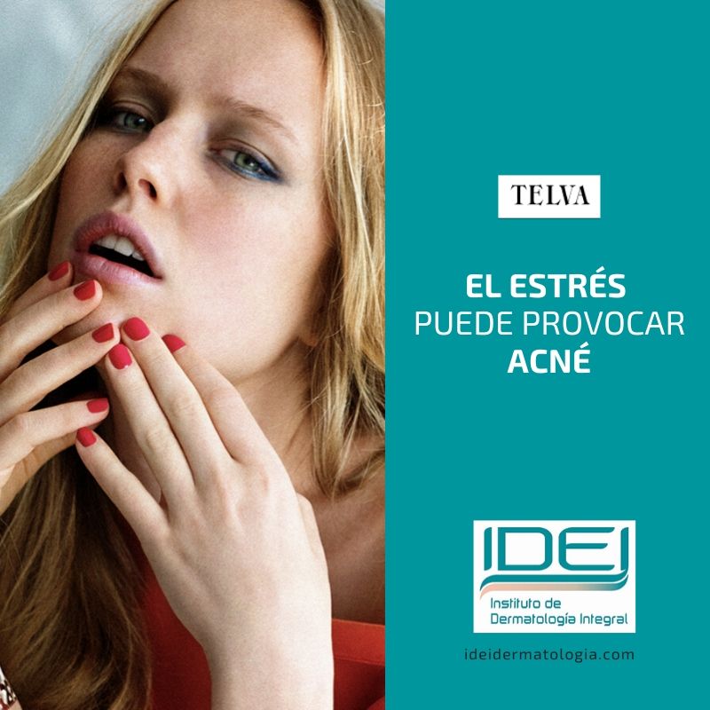 El estrés puede provocar acné