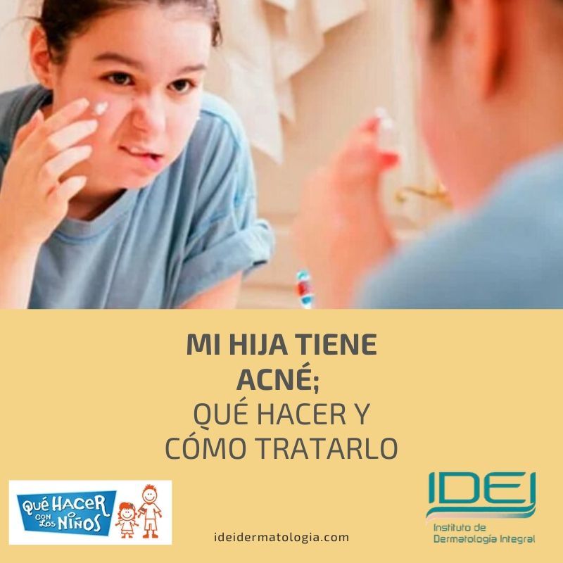Mi hija tiene acné; qué hacer y cómo tratarlo