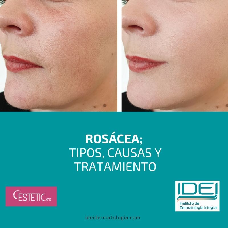Rosácea: tipos, causas y tratamiento