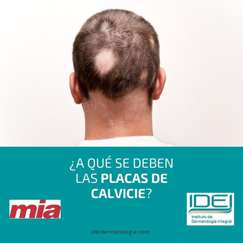 ¿A qué se deben las placas de calvicie?