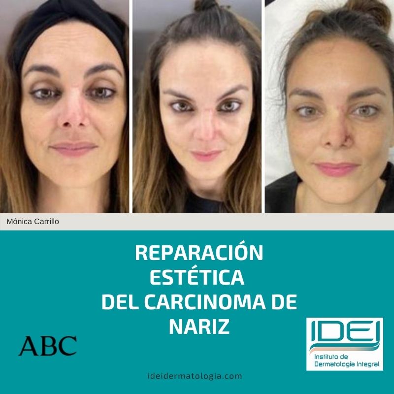 Reparación estética del carcinoma de nariz