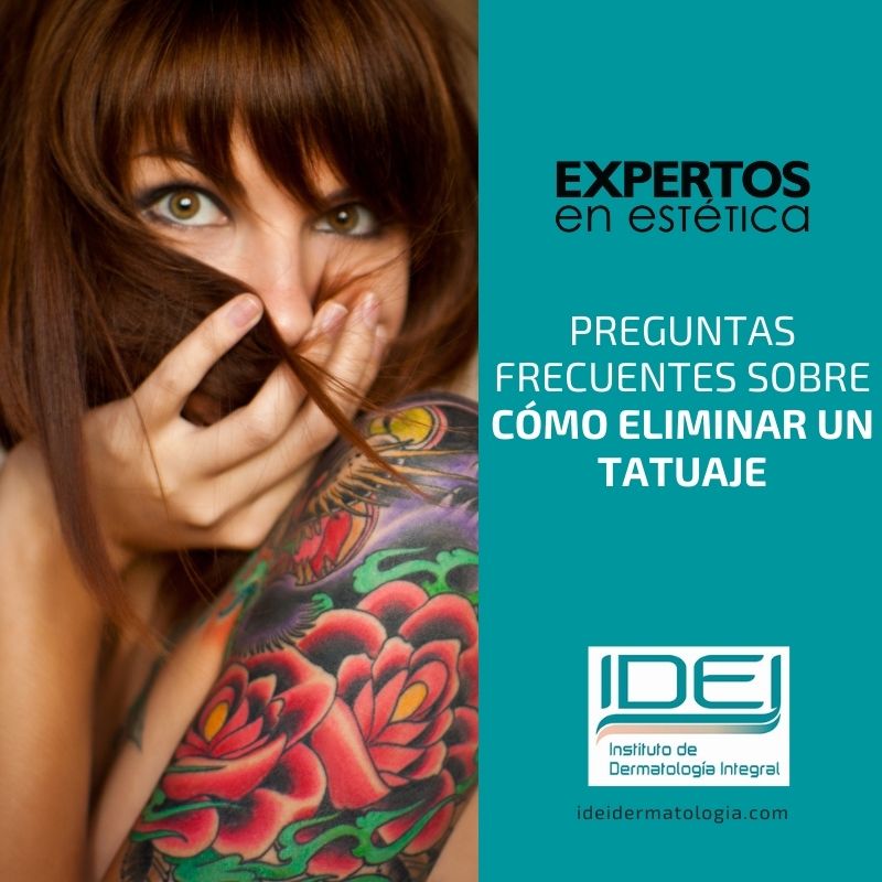 Preguntas frecuentes sobre como eliminar un tatuaje