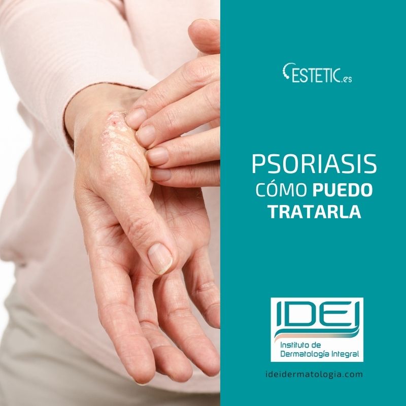 Psoriasis: como puedo tratarla