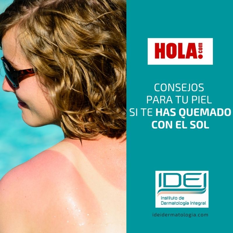 Consejos para tu piel si te has quemado con el sol