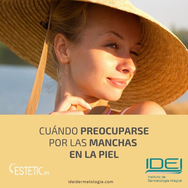Cuándo preocuparse por las manchas en la piel