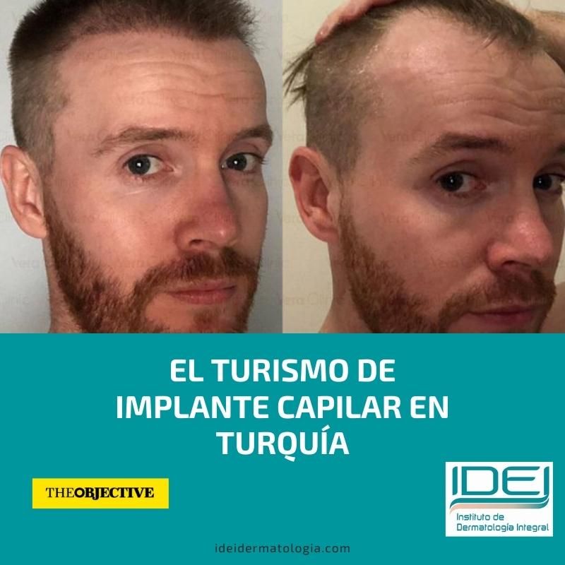 El turismo de implante capilar en Turquía