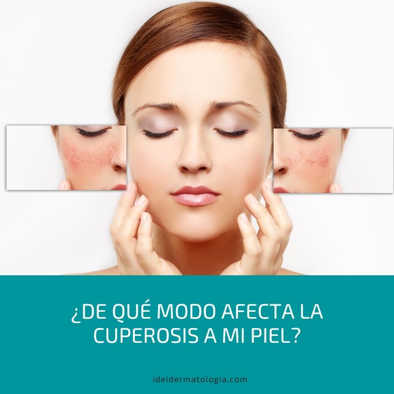 Como afecta la cuperosis a mi piel